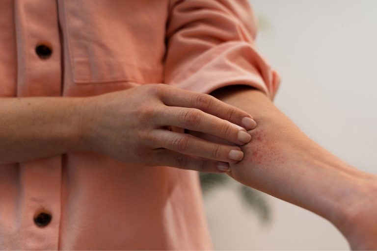 Picadas de Insetos no verão: Como prevenir, identificar e tratar